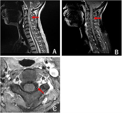 Herpes Zoster Radiculomyelitis With Aquaporin-4 Antibodies: A Case Report and Literature Review